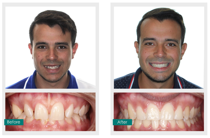 Smile Gallery | Orthodontics Only | Miami FL Orthodontics