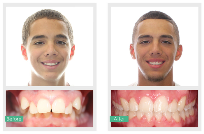 Smile Gallery | Orthodontics Only | Miami FL Orthodontics